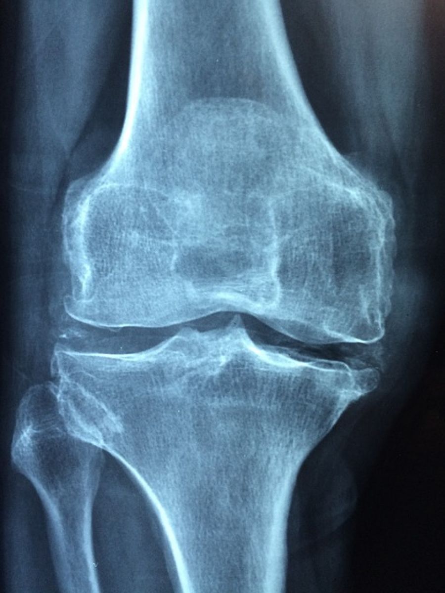 knee x ray knee x ray knee x ray