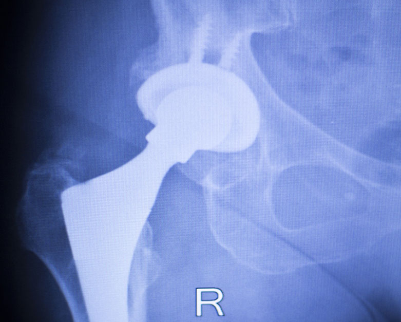 stryker citation hip implant defect